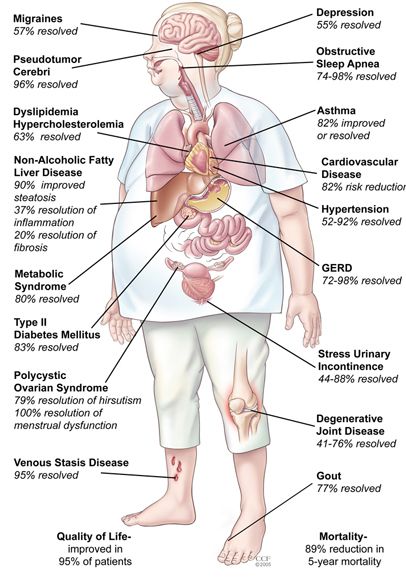 Bariatric Surgery Hospital India, Gastric Bypass Surgery India, Weight Loss Surgery india, Obesity Surgery in India