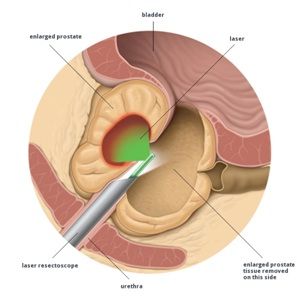 Holmium Laser Enucleation of the prostate
