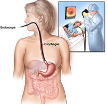 Esophageal Cancers Diagnosed
