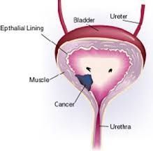  urinary bladder cancer