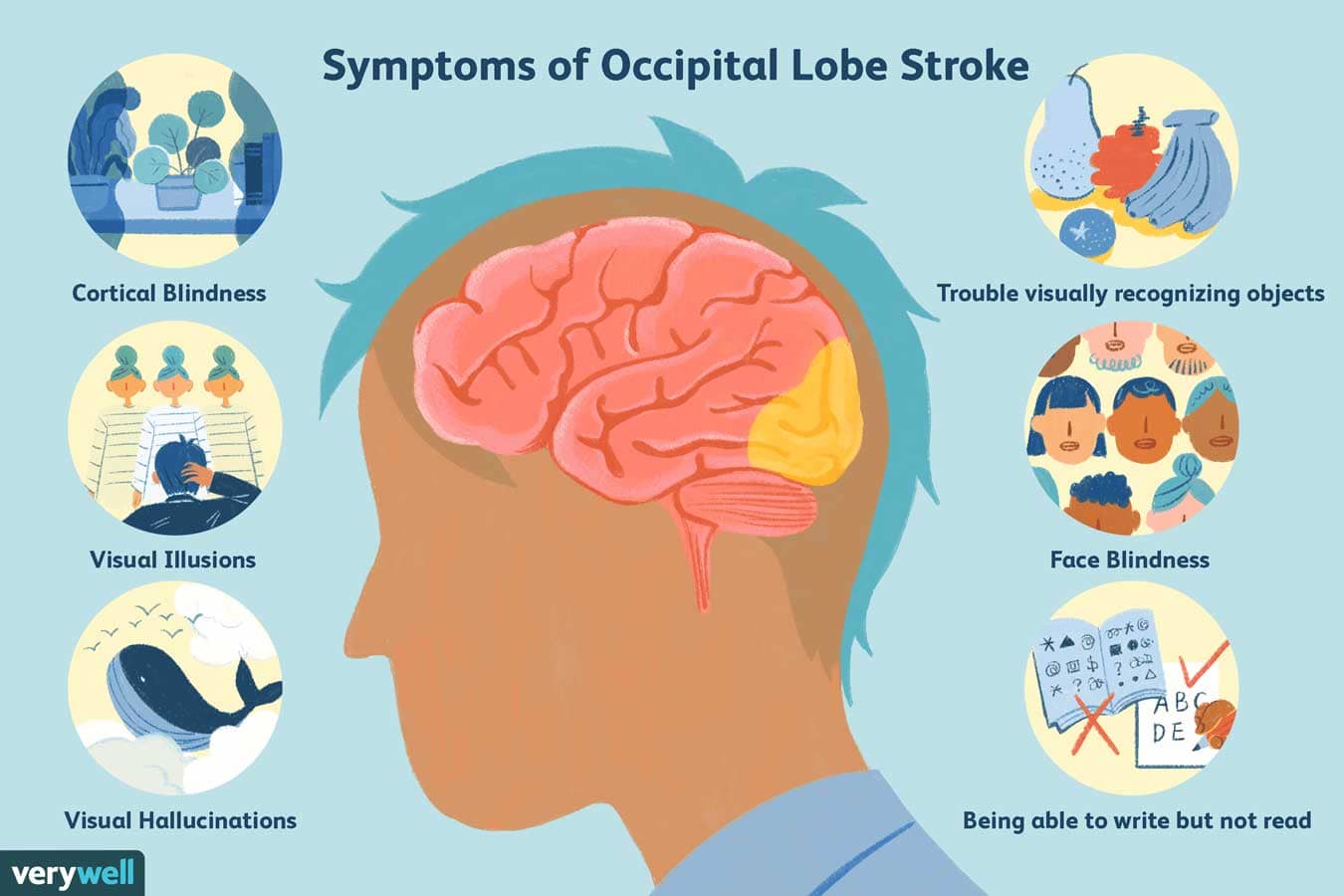 Symptoms of Brain Haemorrhage