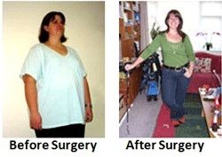 Adjustable Gastric Banding Surgery, Gastric Banding, Gastric Banding Surgery, Laparoscopic Gastric Banding Surgery in India, Minimal Access Gastric Banding, Minimally Invasive Gastric Banding Surgery in India gastric bypass surgery, gastric bypass weight loss, roux-en-y gastric bypass surgery, laparoscopic gastric bypass surgery, laparoscopic gastric bypass, gastric bypass surgical procedure