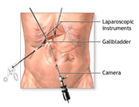 Highly Advanced Laparoscopic Surgery