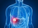 liver cancer