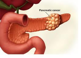 Pancreas Cancer