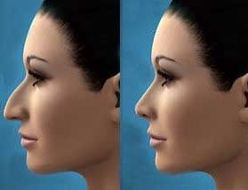 Rhinoplasty