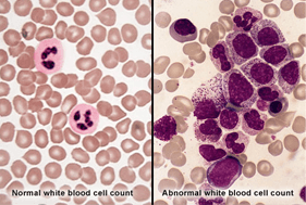 Leukemia