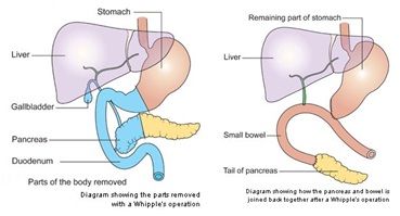 Standard Whipple Procedure