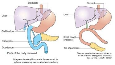 Pylorus Preserving Whipple Procedure