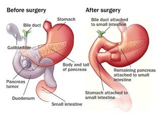 Whipple operation on diabetes